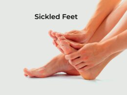 Sickled Feet