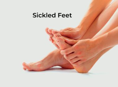 Sickled Feet