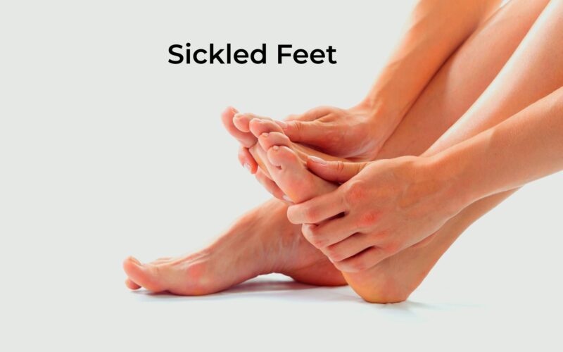 Sickled Feet